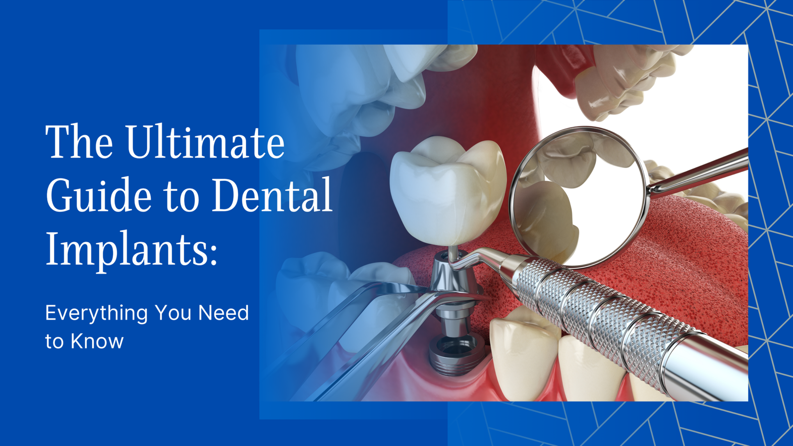 The Ultimate Guide To Dental Implants Everything You Need To Know Dr