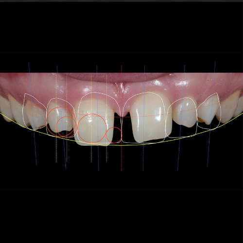 Preventing Cavities