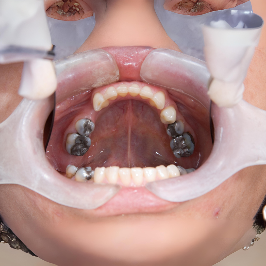 Millennials Getting More Cavities