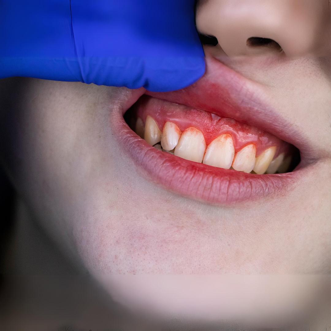 Treat Teeth and Gums