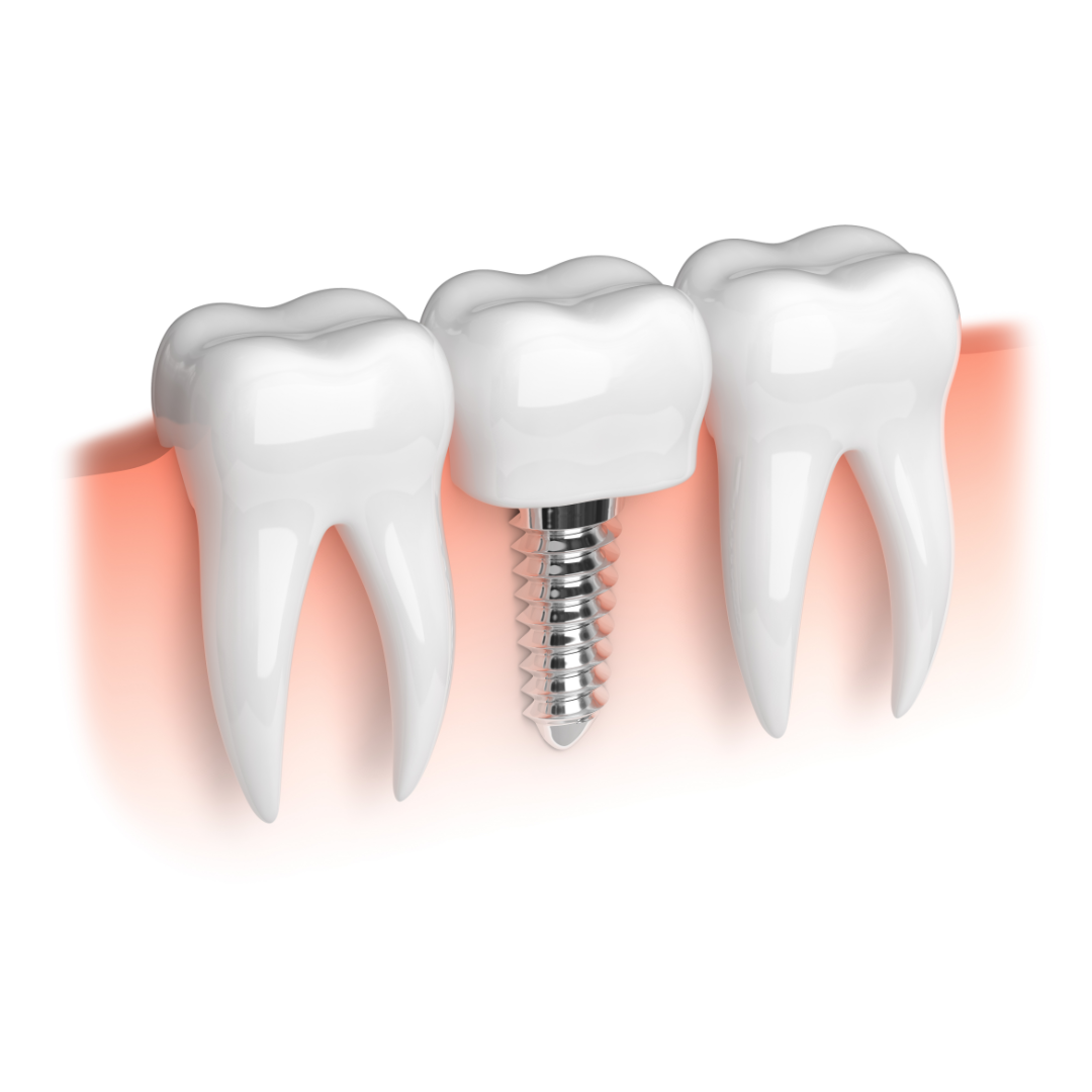 This ultimate guide to root canal treatment aims to provide comprehensive information to help you understand and feel confident about the process.