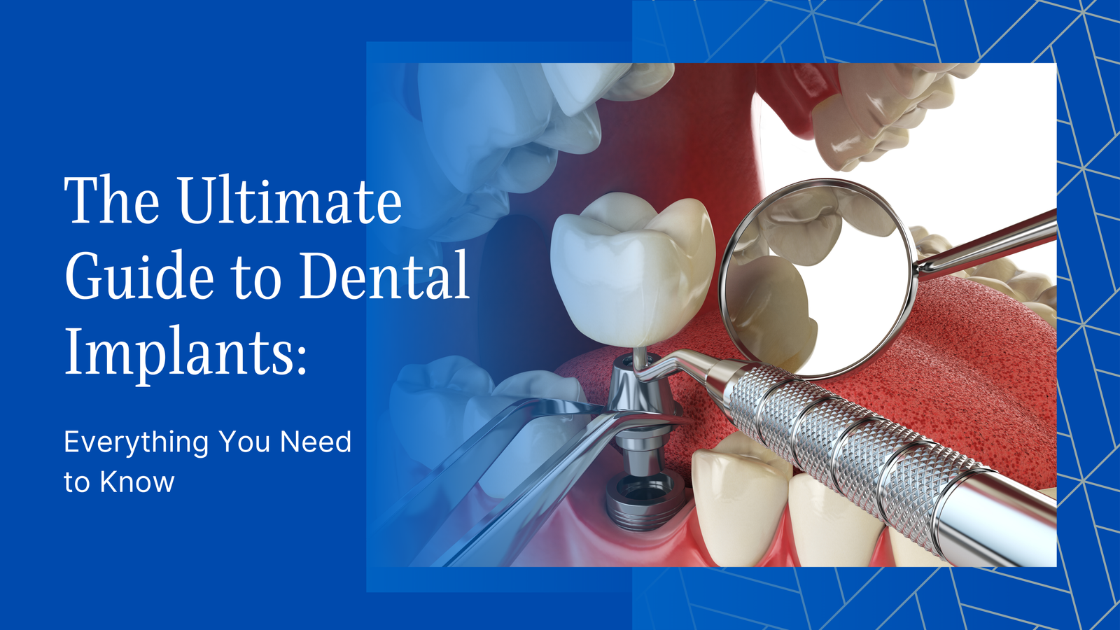 Tooth Loss